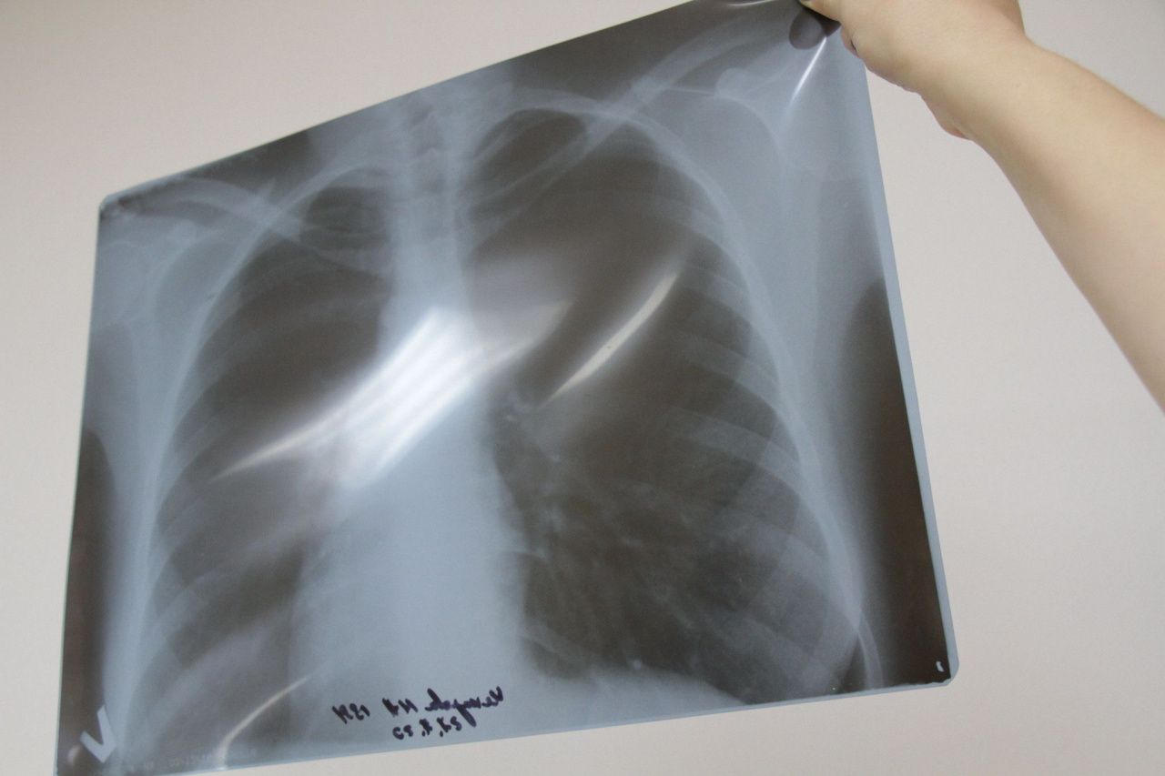 В Гари и Сосьву приедет передвижной флюорограф