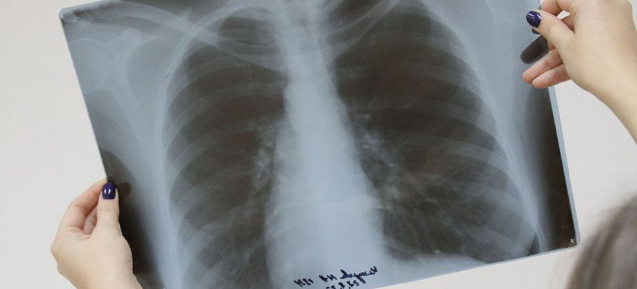 Жителей Восточного и Сосьвы зовут пройти флюорографическое обследование